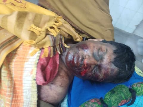 চাঁপাইনবাবগঞ্জে রোদে শুকাতে দেয়া ককটেল বিস্ফোরণে আহত ১