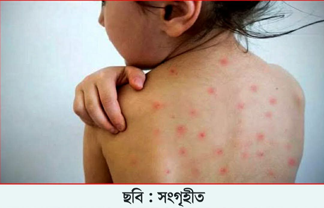 ফরিদপুর জেলায় হামের সংক্রমণ পরিস্থিতি উদ্বেগজনক  নতুন করে ৩৯ জন আক্রান্ত